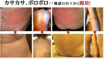 乾癬2週間脱出 カサカサ肌・乾燥肌改善 治す 方法